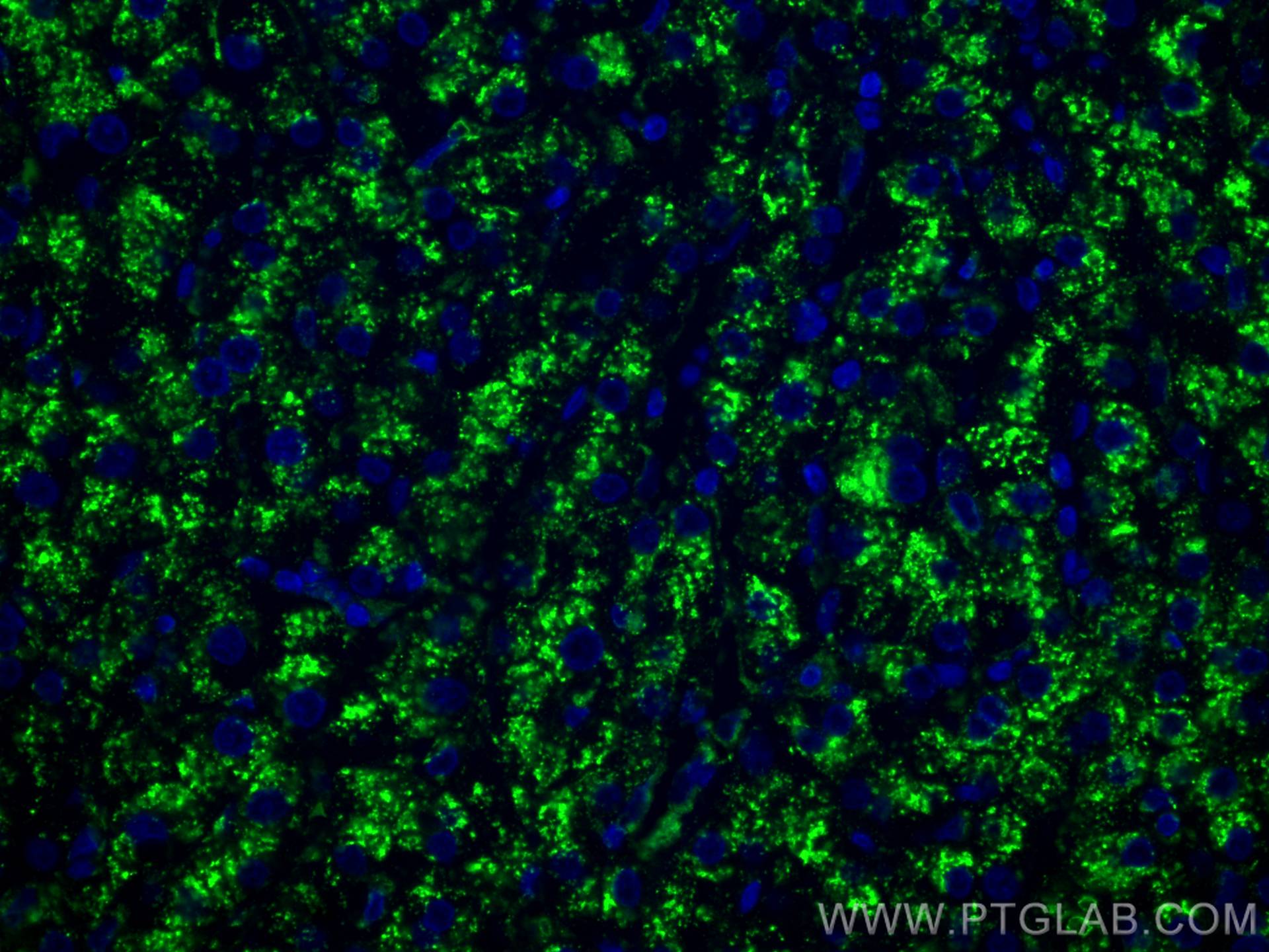 Immunofluorescence (IF) / fluorescent staining of human liver cancer tissue using CD107a / LAMP1 Monoclonal antibody (67300-1-Ig)