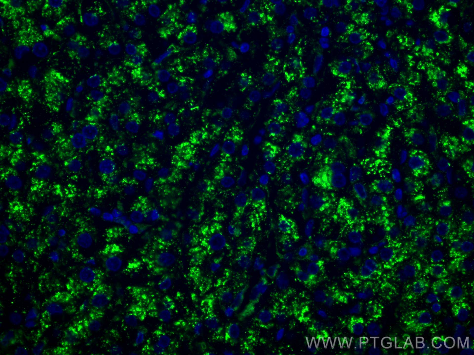 IF Staining of human liver cancer using 67300-1-Ig