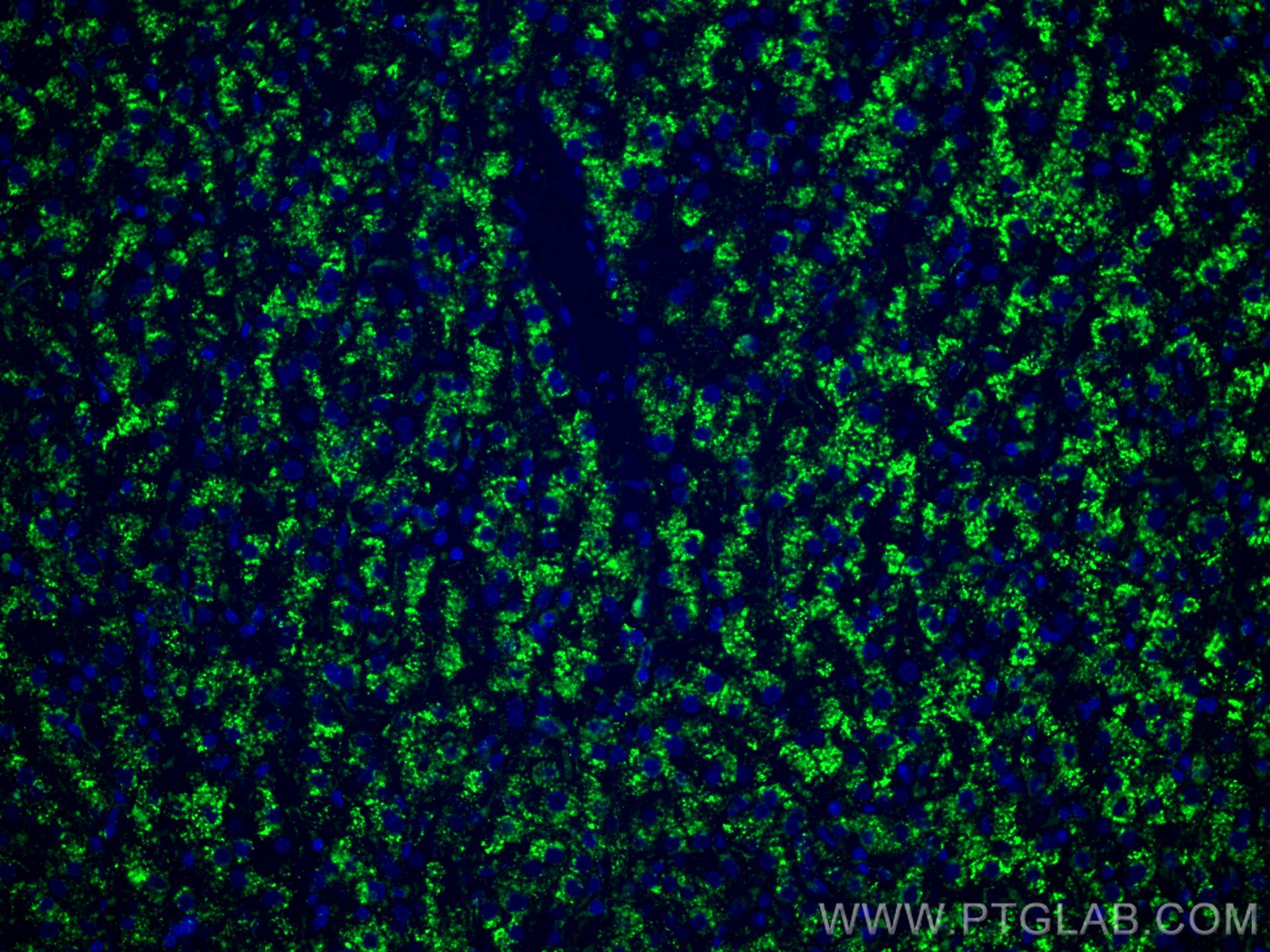 Immunofluorescence (IF) / fluorescent staining of human liver cancer tissue using CD107a / LAMP1 Monoclonal antibody (67300-1-Ig)