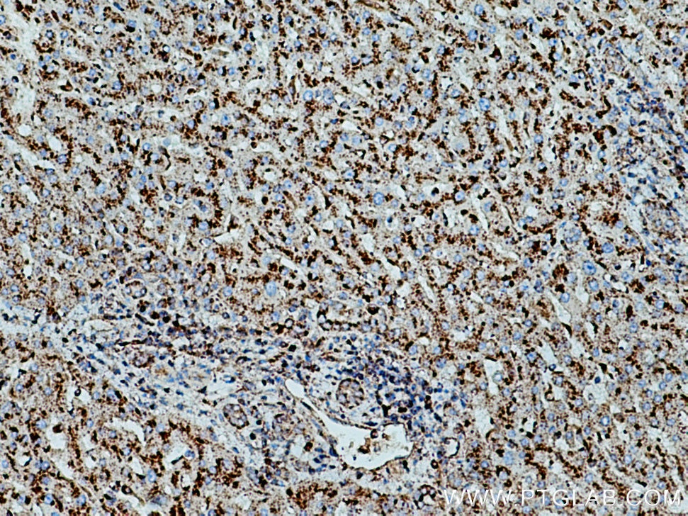 Immunohistochemistry (IHC) staining of human liver cancer tissue using CD107a / LAMP1 Monoclonal antibody (67300-1-Ig)