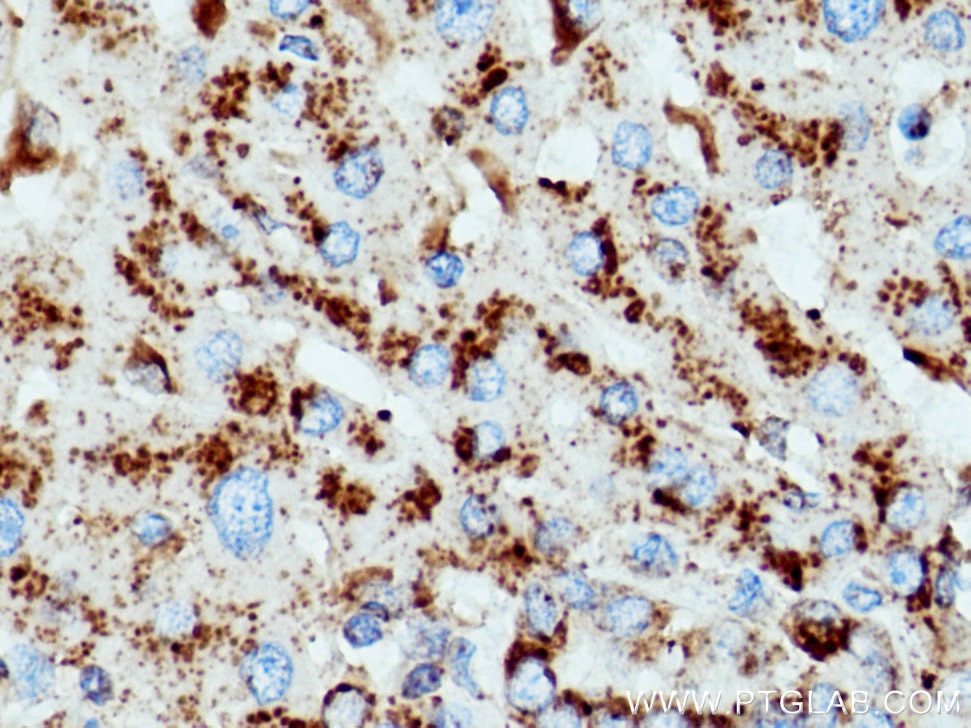 Immunohistochemistry (IHC) staining of human liver cancer tissue using CD107a / LAMP1 Monoclonal antibody (67300-1-Ig)