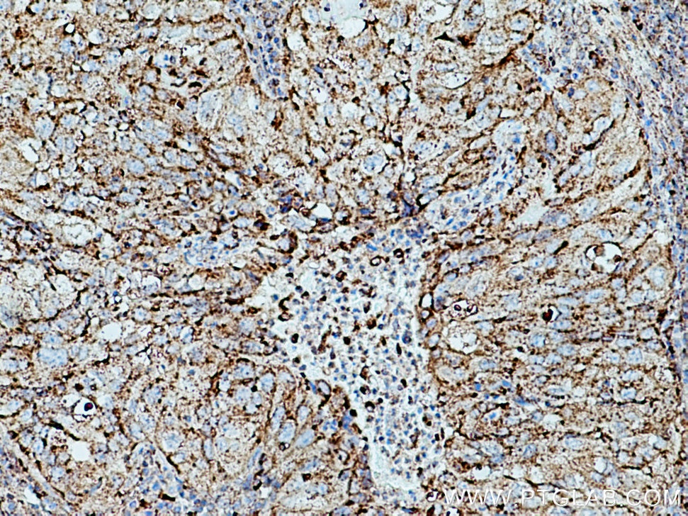 Immunohistochemistry (IHC) staining of human lung cancer tissue using CD107a / LAMP1 Monoclonal antibody (67300-1-Ig)