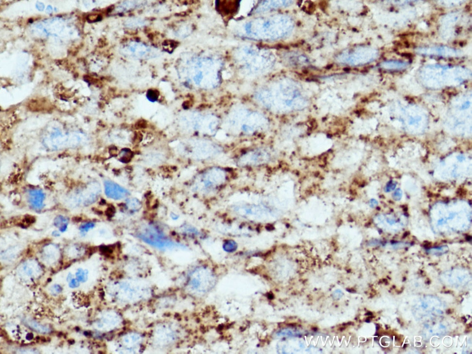 Immunohistochemistry (IHC) staining of human lung cancer tissue using CD107a / LAMP1 Monoclonal antibody (67300-1-Ig)