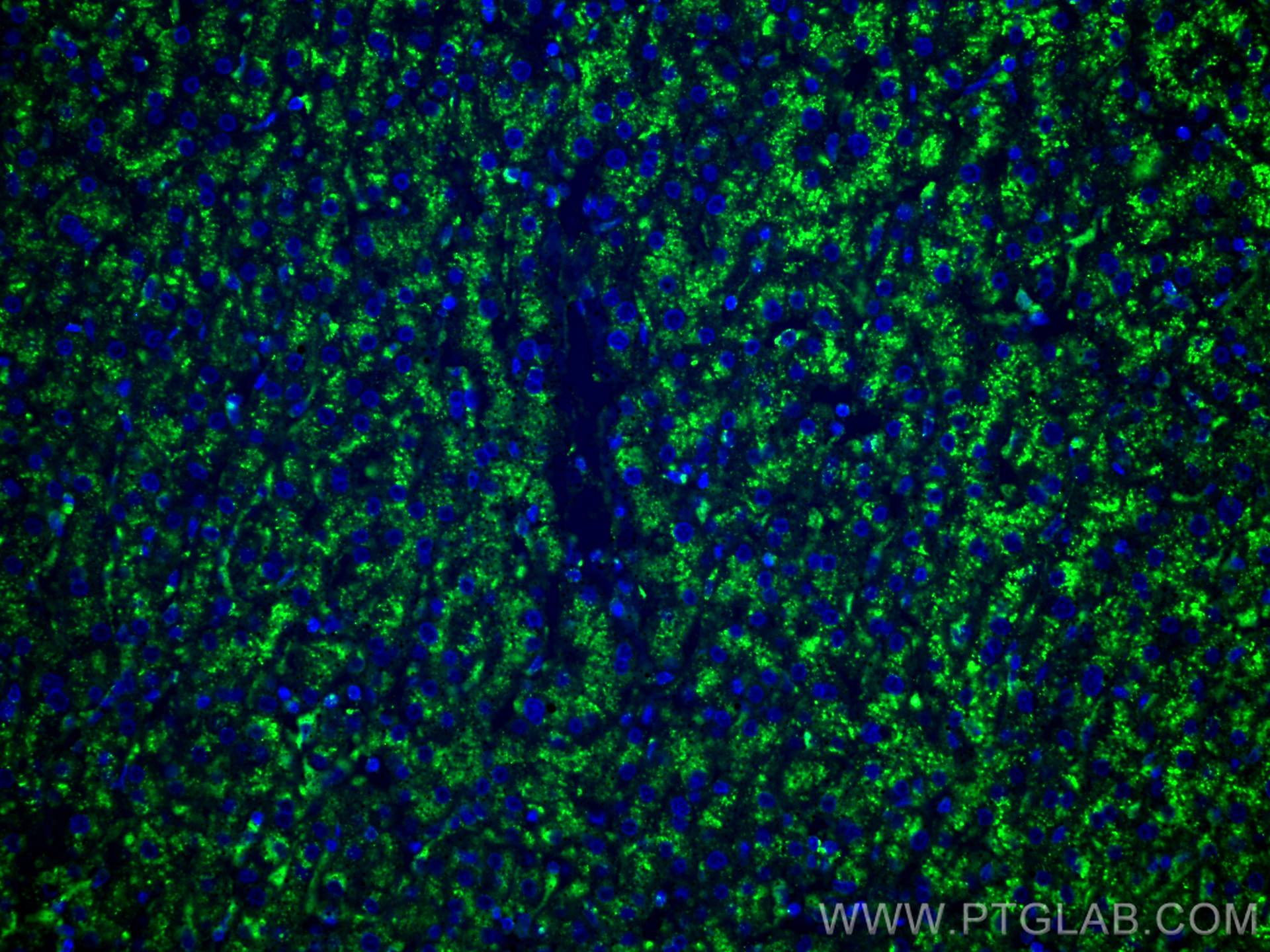 Immunofluorescence (IF) / fluorescent staining of human liver cancer tissue using CoraLite® Plus 488-conjugated CD107a / LAMP1 Monoc (CL488-67300)
