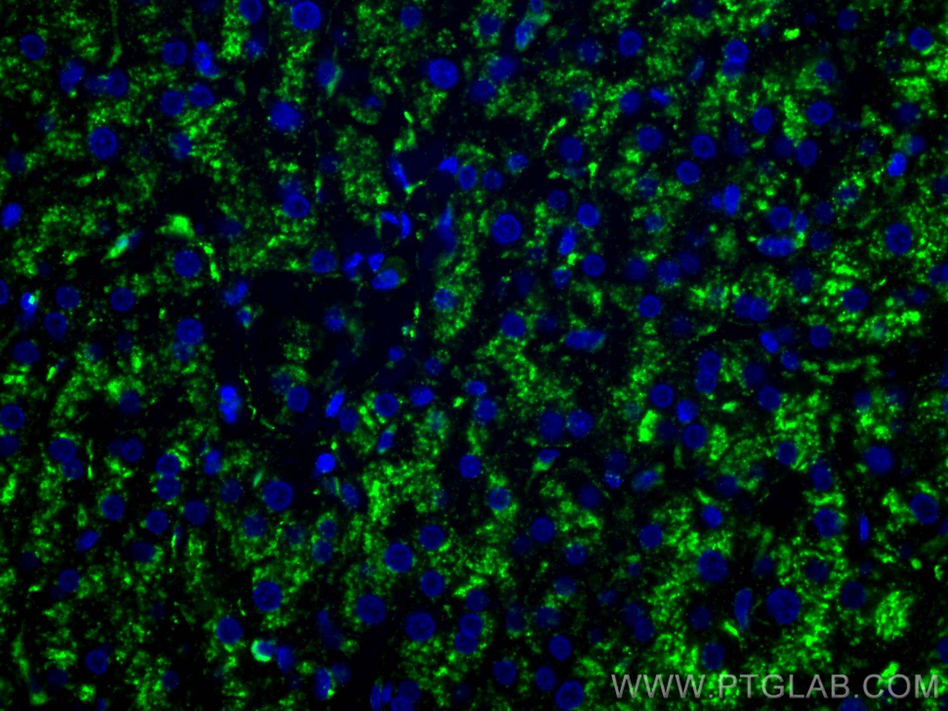 Immunofluorescence (IF) / fluorescent staining of human liver cancer tissue using CoraLite® Plus 488-conjugated CD107a / LAMP1 Monoc (CL488-67300)