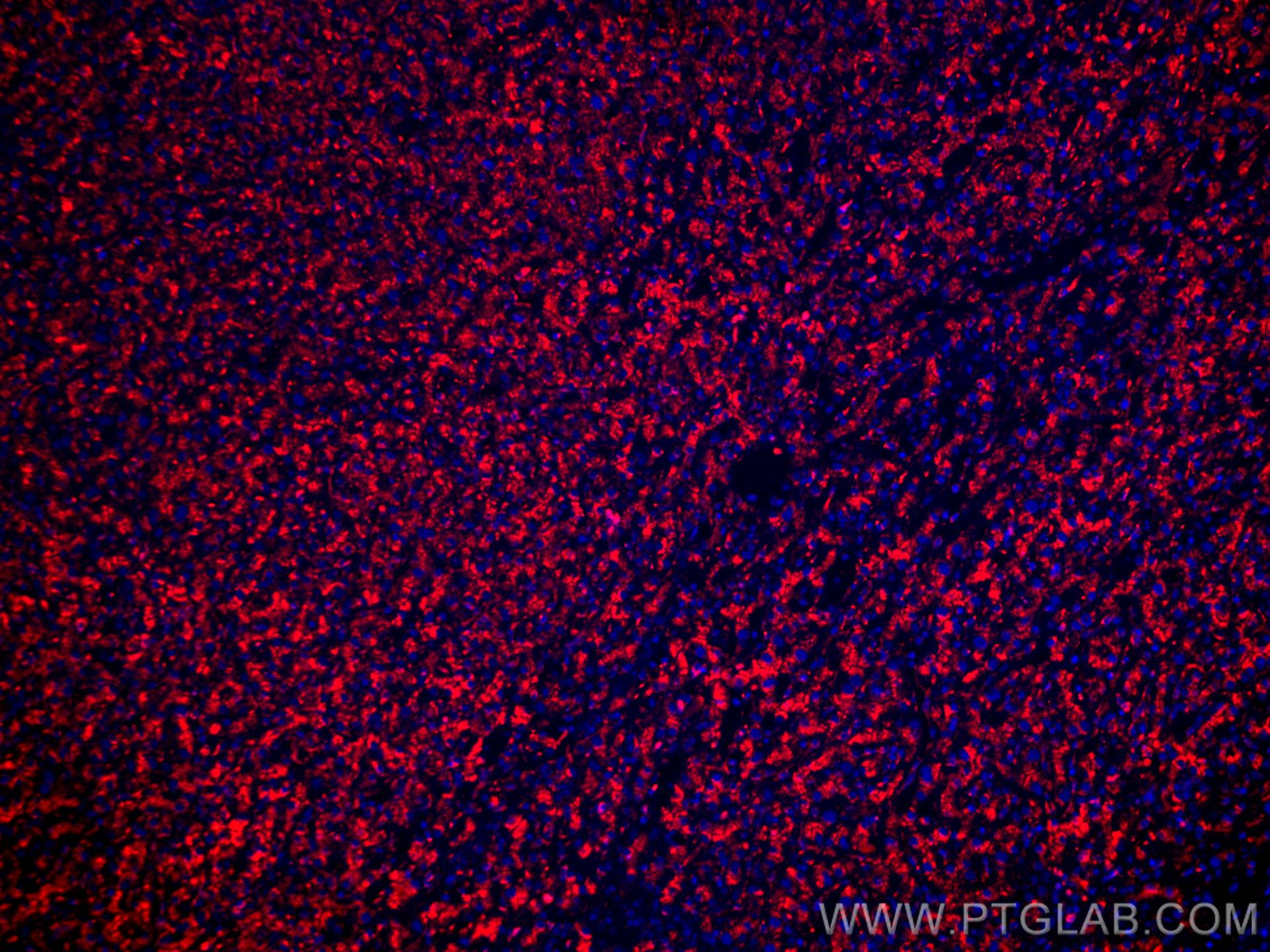 Immunofluorescence (IF) / fluorescent staining of human liver cancer tissue using CoraLite®594-conjugated CD107a / LAMP1 Monoclonal  (CL594-67300)