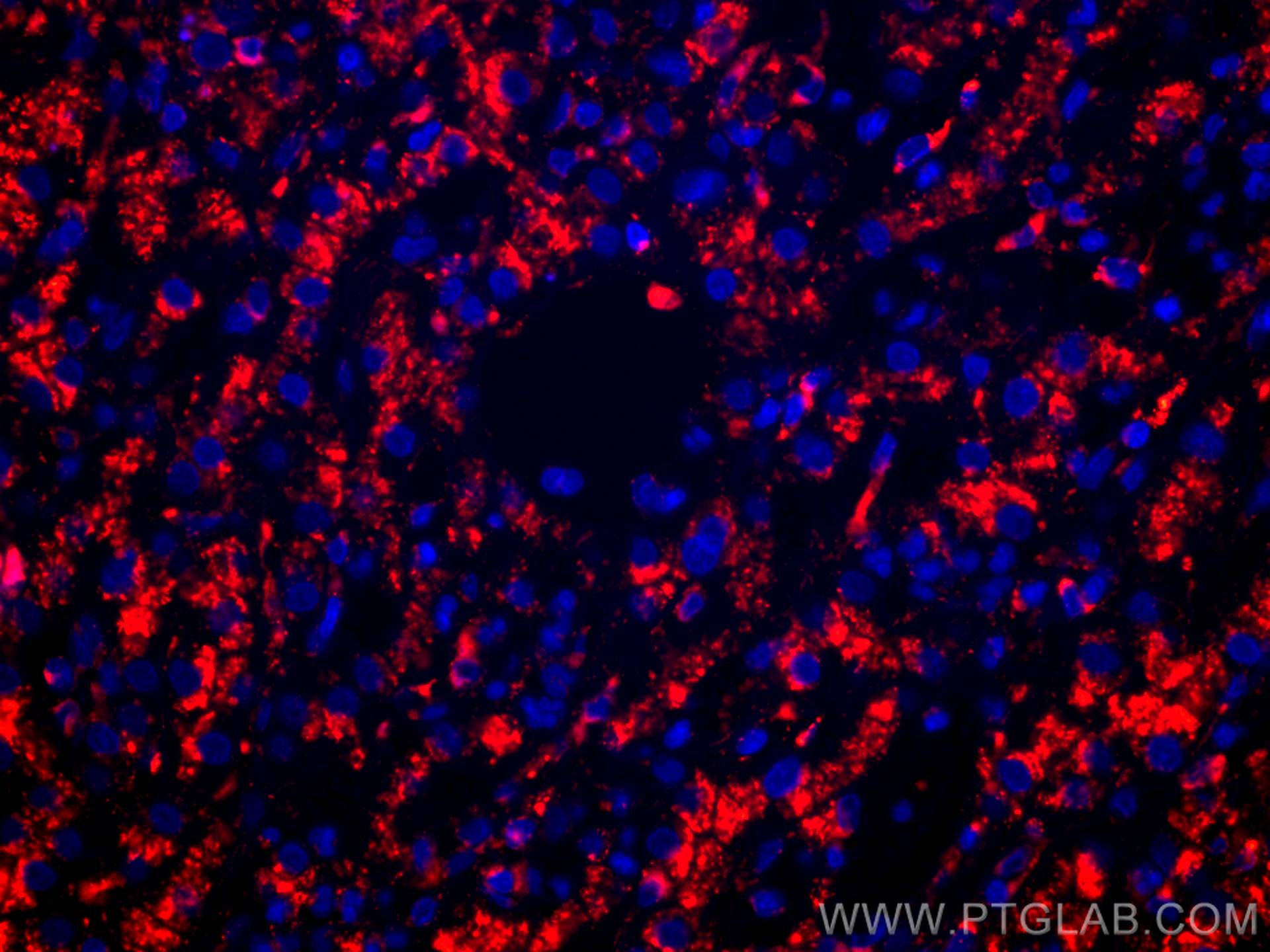 Immunofluorescence (IF) / fluorescent staining of human liver cancer tissue using CoraLite®594-conjugated CD107a / LAMP1 Monoclonal  (CL594-67300)