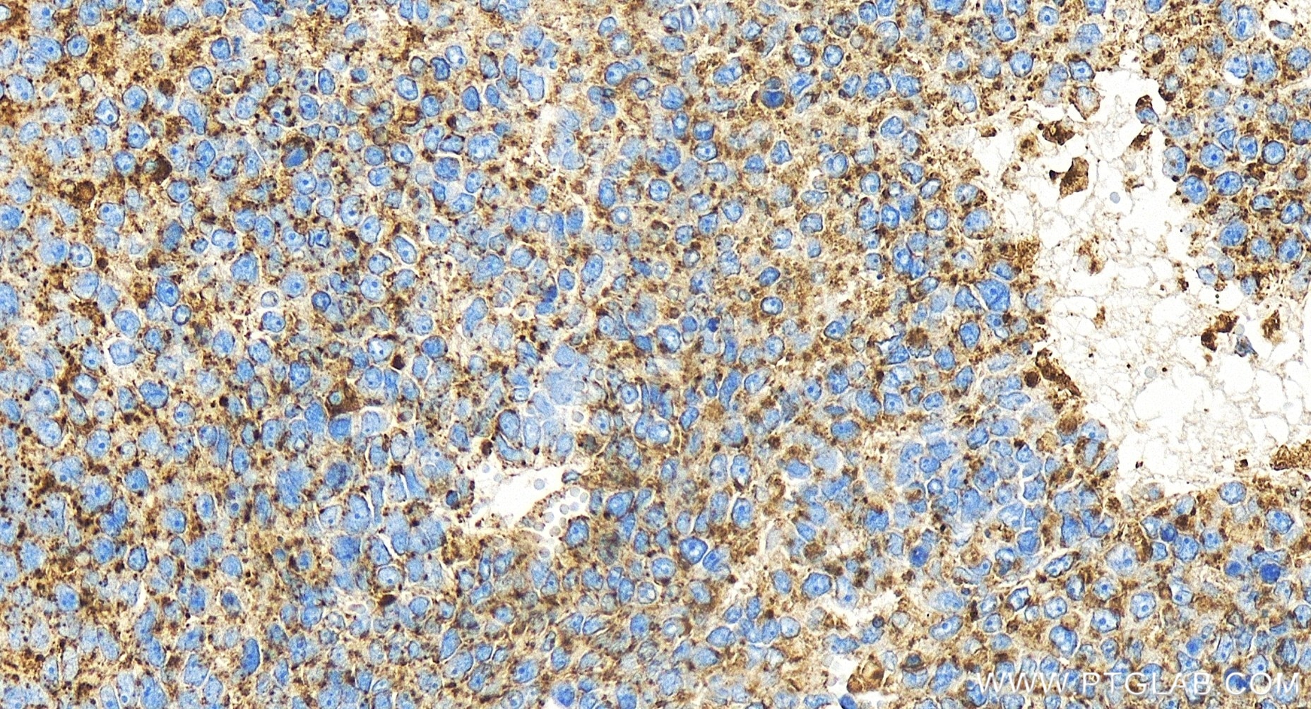 Immunohistochemistry (IHC) staining of human liver cancer tissue using CD107a / LAMP1 Recombinant antibody (84658-5-RR)
