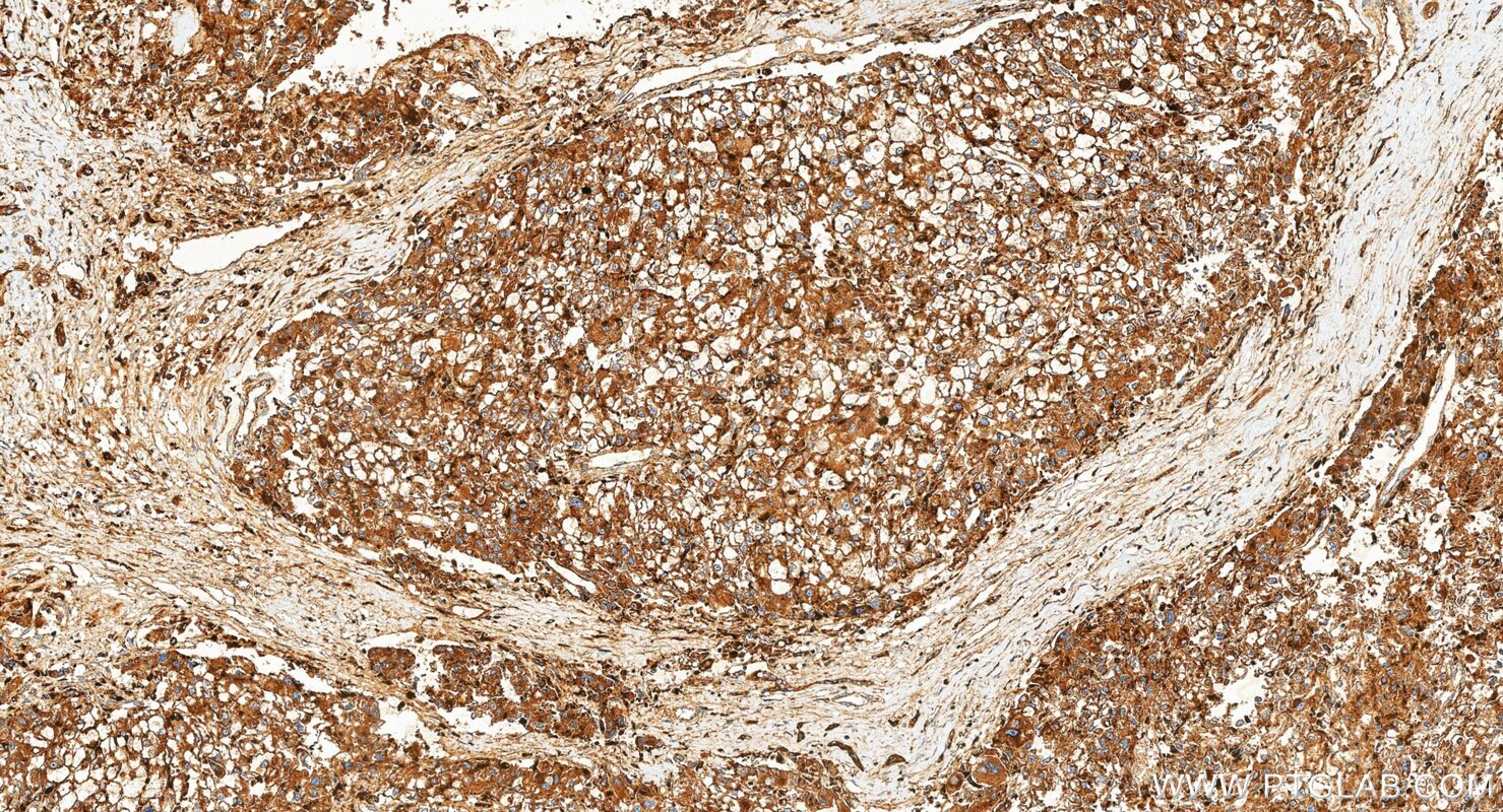 IHC staining of human liver cancer using 34523-1-AP Immunohistochemistry (IHC) staining of human liver cancer tissue using CD107b / LAMP2 Polyclonal antibody (34523-1-AP)