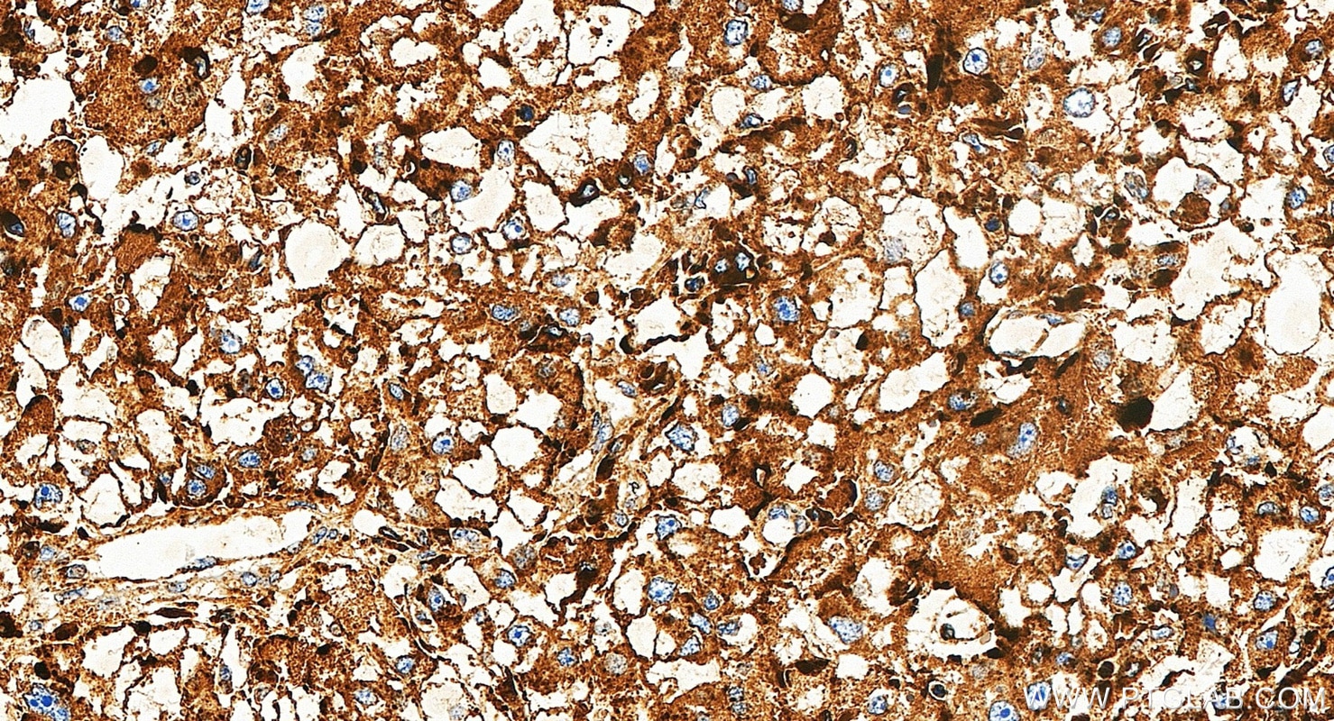 IHC staining of human liver cancer using 34523-1-AP Immunohistochemistry (IHC) staining of human liver cancer tissue using CD107b / LAMP2 Polyclonal antibody (34523-1-AP)