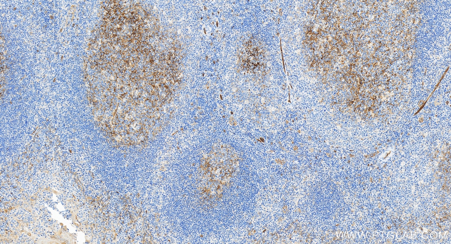 Immunohistochemistry (IHC) staining of human tonsillitis tissue using CD109 Recombinant antibody (85924-4-RR)