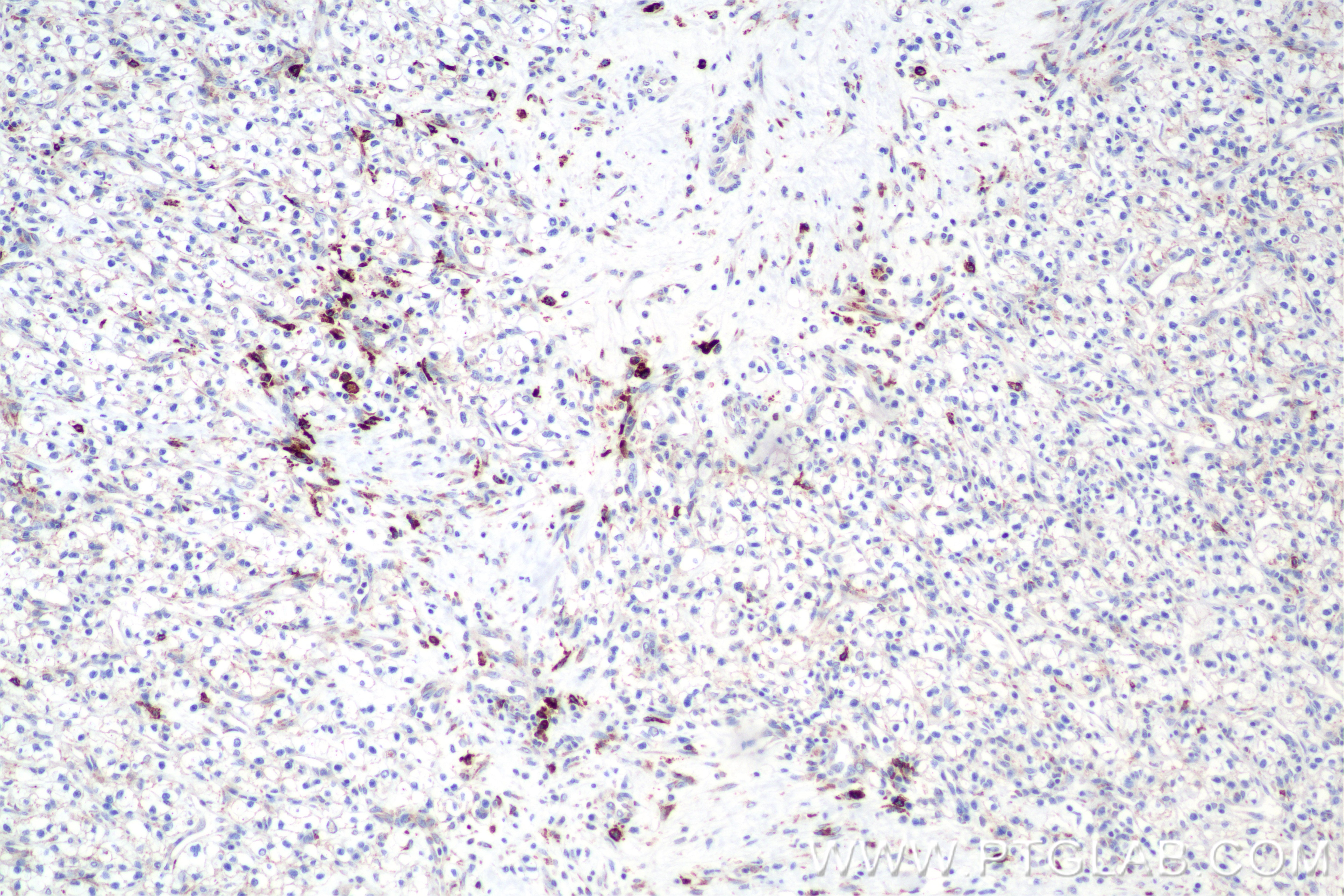 Immunohistochemical analysis of paraffin-embedded Human Kidney(renal cell) Cancer slide using 84259-10-RR (C-Kit antibody) at dilution of 1:1000 (under 10x lens). Heat mediated antigen retrieval with Tris-EDTA buffer (pH 9.0). Immunohistochemistry (IHC) staining of Human Kidney(renal cell) Cancer using CD117/c-Kit Recombinant antibody (84259-10-RR)