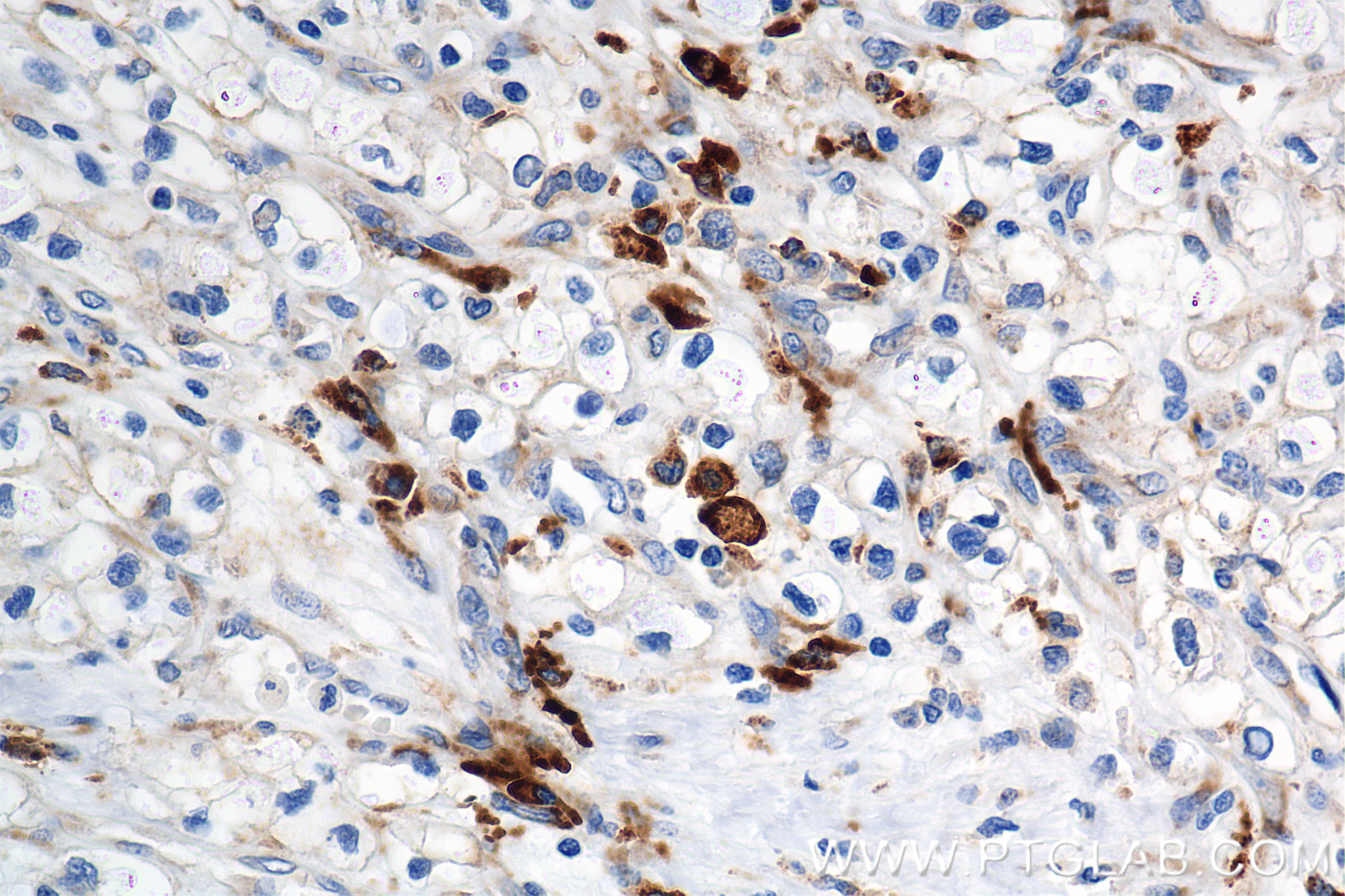 Immunohistochemical analysis of paraffin-embedded Human Kidney(renal cell) Cancer slide using 84259-10-RR (C-Kit antibody) at dilution of 1:1000 (under 40x lens). Heat mediated antigen retrieval with Tris-EDTA buffer (pH 9.0). Immunohistochemistry (IHC) staining of Human Kidney(renal cell) Cancer using CD117/c-Kit Recombinant antibody (84259-10-RR)