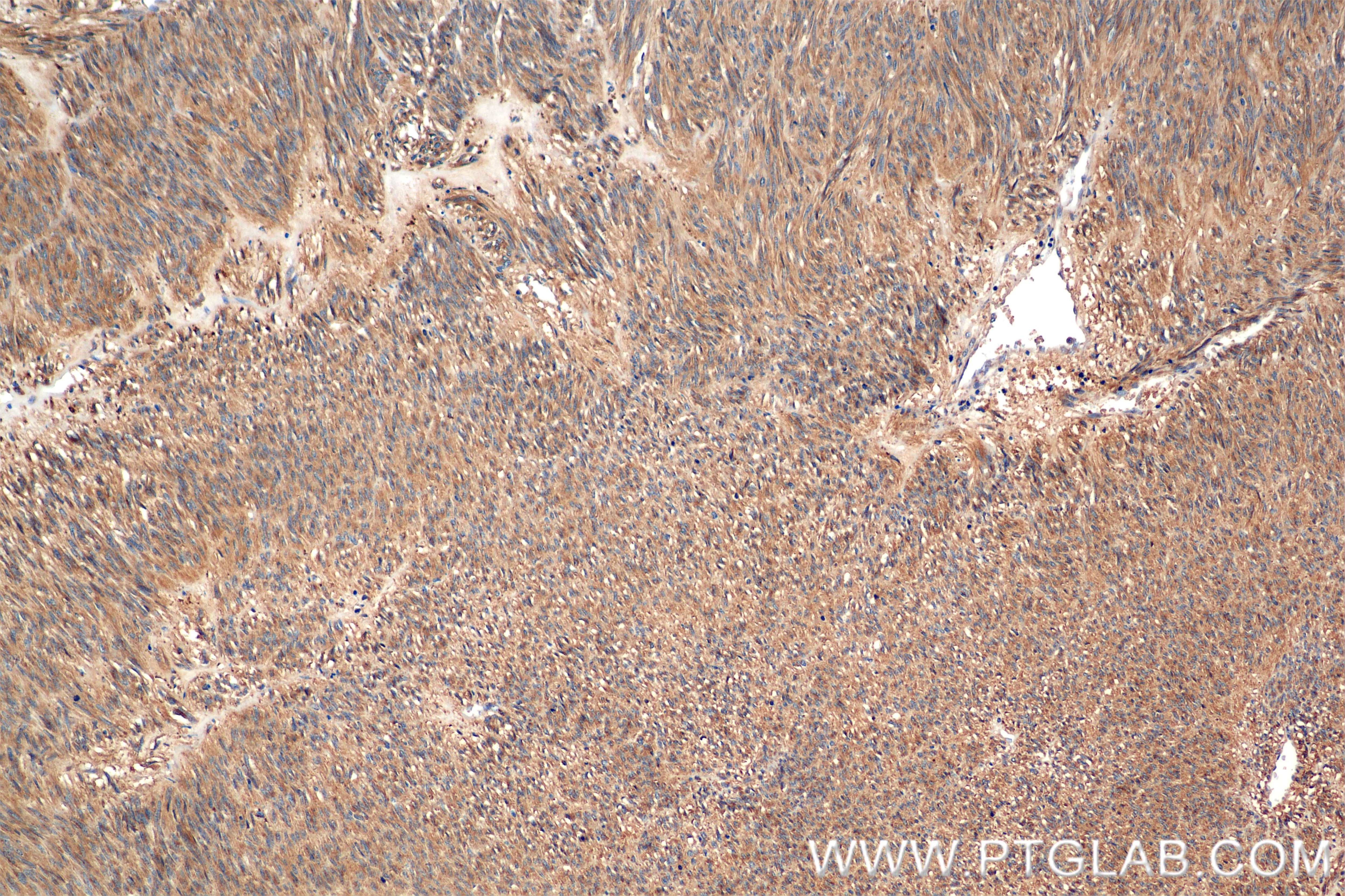 Immunohistochemical analysis of paraffin-embedded Gastrointestinal Stromal Tumor tissue slide using 84259-10-RR (C-Kit antibody) at dilution of 1:500 (under 10x lens). Heat mediated antigen retrieval with Tris-EDTA buffer (pH 9.0). Immunohistochemistry (IHC) staining of Gastrointestinal Stromal Tumor tissue using CD117/c-Kit Recombinant antibody (84259-10-RR)