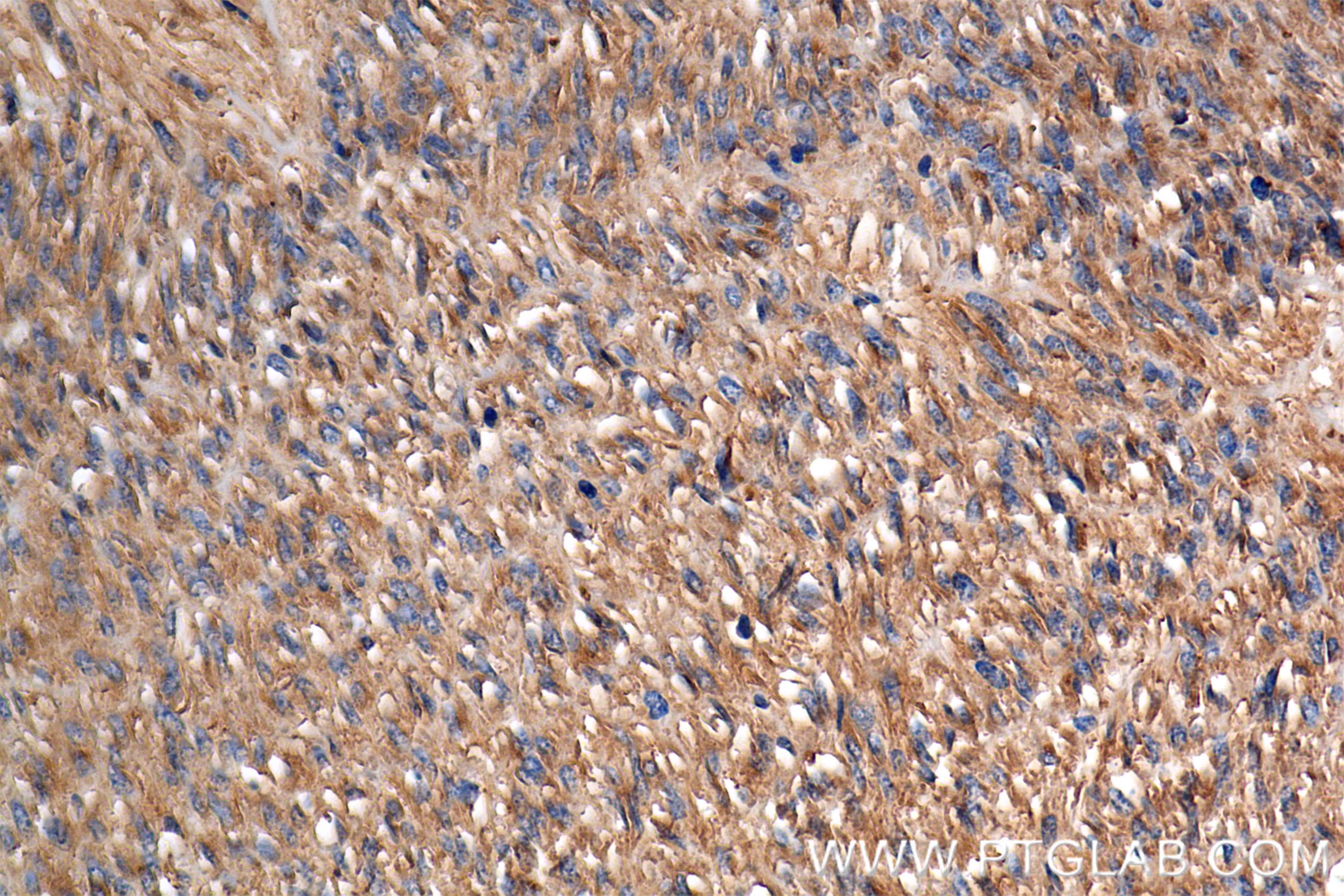 Immunohistochemical analysis of paraffin-embedded Gastrointestinal Stromal Tumor tissue slide using 84259-10-RR (C-Kit antibody) at dilution of 1:500 (under 40x lens). Heat mediated antigen retrieval with Tris-EDTA buffer (pH 9.0). Immunohistochemistry (IHC) staining of Gastrointestinal Stromal Tumor tissue using CD117/c-Kit Recombinant antibody (84259-10-RR)