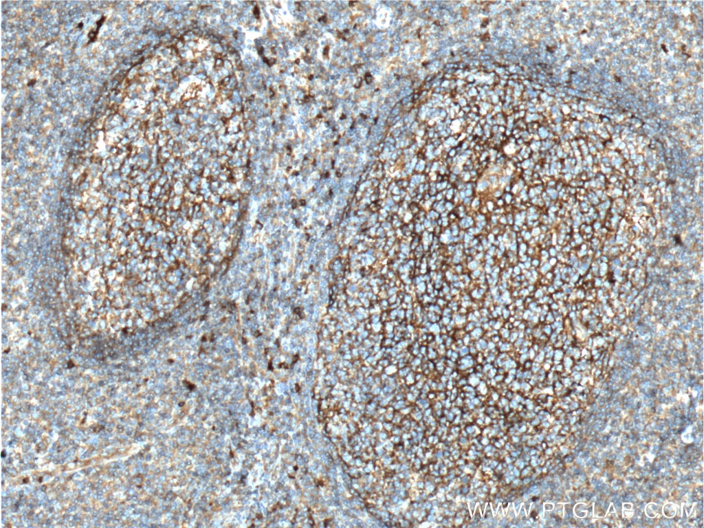 Immunohistochemistry (IHC) staining of human tonsillitis tissue using CD11B/Integrin Alpha M Polyclonal antibody (20991-1-AP)