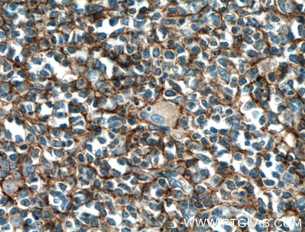 Immunohistochemistry (IHC) staining of human tonsillitis tissue using CD11B/Integrin Alpha M Monoclonal antibody (66519-1-Ig)