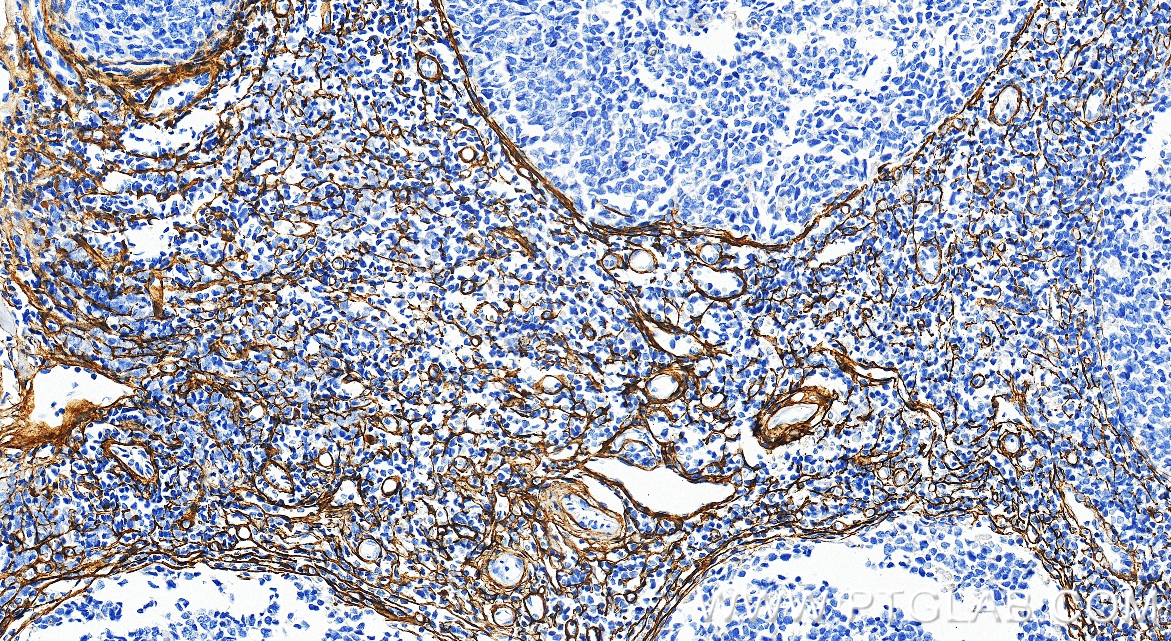 Immunohistochemistry (IHC) staining of human tonsillitis tissue using CD11a Recombinant monoclonal antibody (87542-1-RR)