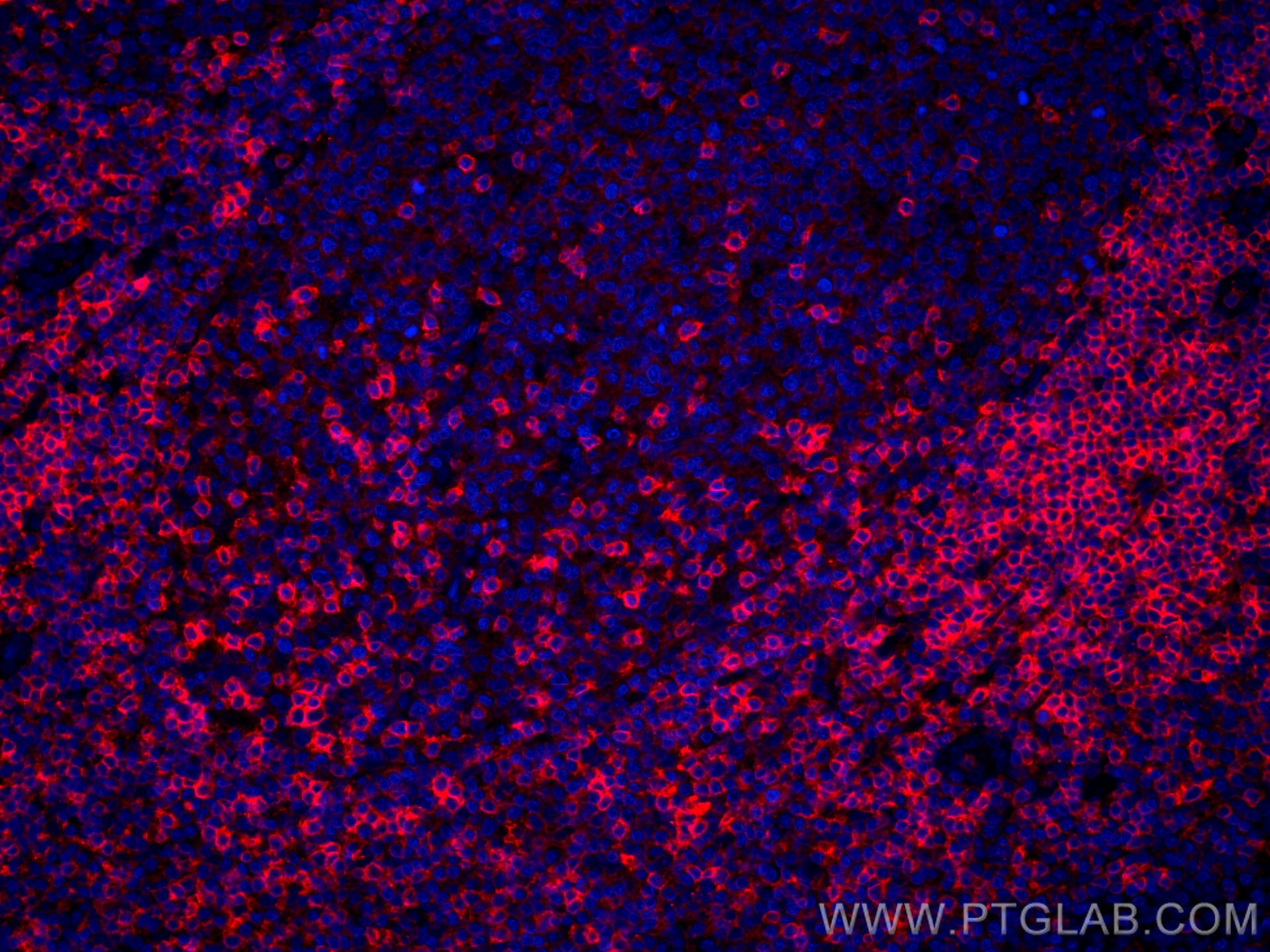 Immunofluorescence (IF) / fluorescent staining of human tonsillitis tissue using CoraLite®594-conjugated CD11a/Integrin Alpha L Mon (CL594-66256)