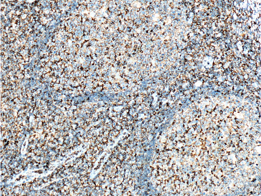 Immunohistochemistry (IHC) staining of human tonsillitis tissue using CD11a/Integrin Alpha L Monoclonal antibody (66256-1-Ig)