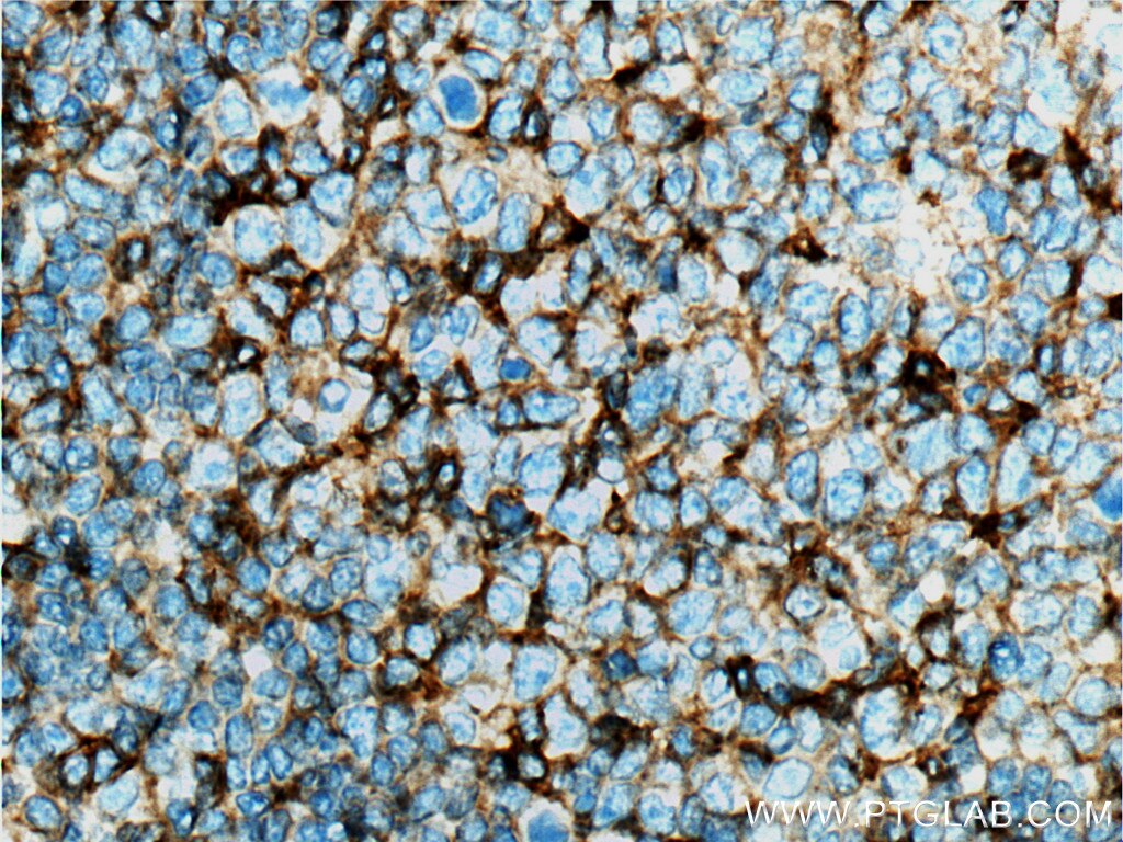 Immunohistochemistry (IHC) staining of human tonsillitis tissue using CD11a/Integrin Alpha L Monoclonal antibody (66256-1-Ig)