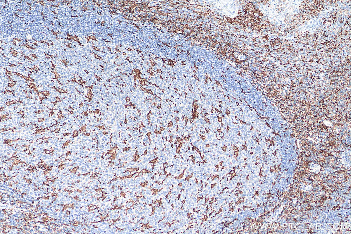 Immunohistochemistry (IHC) staining of human tonsillitis tissue using CD11c/Integrin alpha X Recombinant antibody (81853-1-RR)