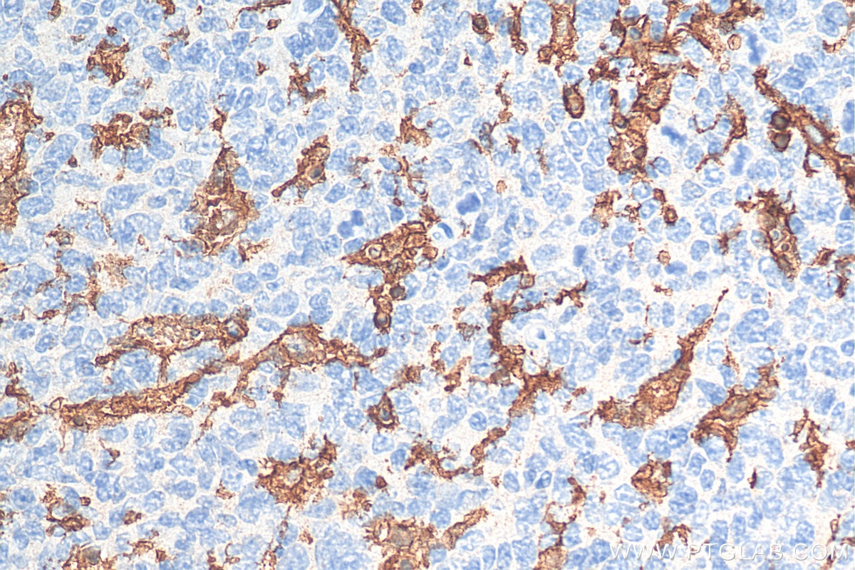 Immunohistochemistry (IHC) staining of human tonsillitis tissue using CD11c/Integrin alpha X Recombinant antibody (81853-1-RR)