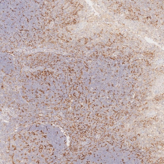 IHC staining of human tonsillitis using 81853-1-RR Immunohistochemistry (IHC) staining of human tonsillitis tissue using CD11c Recombinant monoclonal antibody (81853-1-RR)
