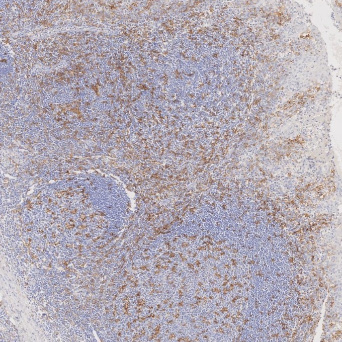 IHC staining of human tonsillitis using 81853-1-RR Immunohistochemistry (IHC) staining of human tonsillitis tissue using CD11c Recombinant monoclonal antibody (81853-1-RR)