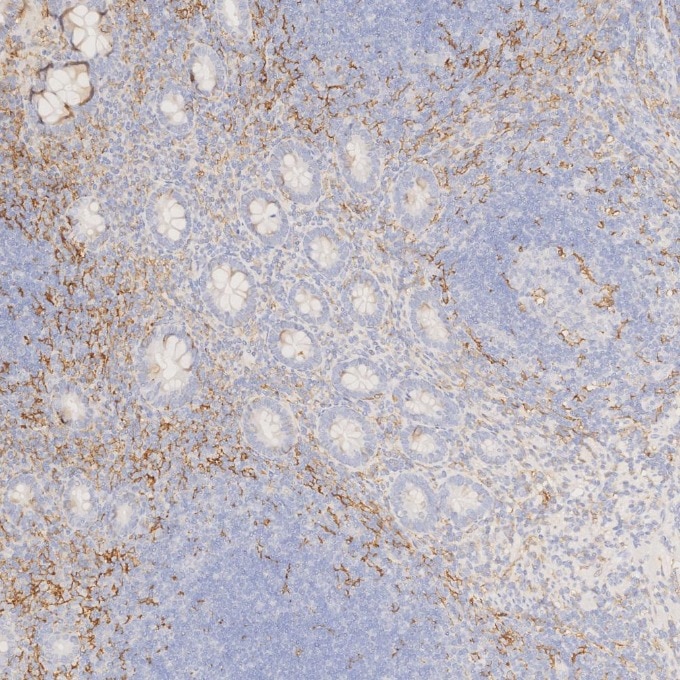 IHC staining of human appendicitis using 81853-1-RR Immunohistochemistry (IHC) staining of human appendicitis tissue using CD11c Recombinant monoclonal antibody (81853-1-RR)