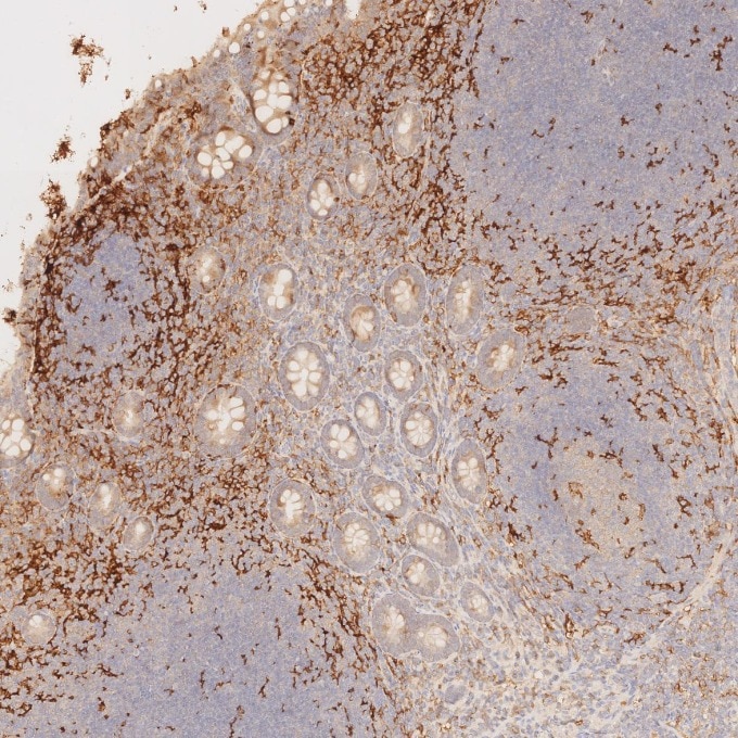 IHC staining of human appendicitis using 81853-1-RR Immunohistochemistry (IHC) staining of human appendicitis tissue using CD11c Recombinant monoclonal antibody (81853-1-RR)
