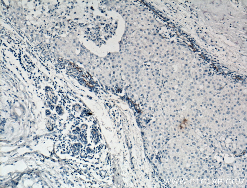 Immunohistochemistry (IHC) staining of human breast cancer tissue using CD133 Monoclonal antibody (66666-1-Ig)