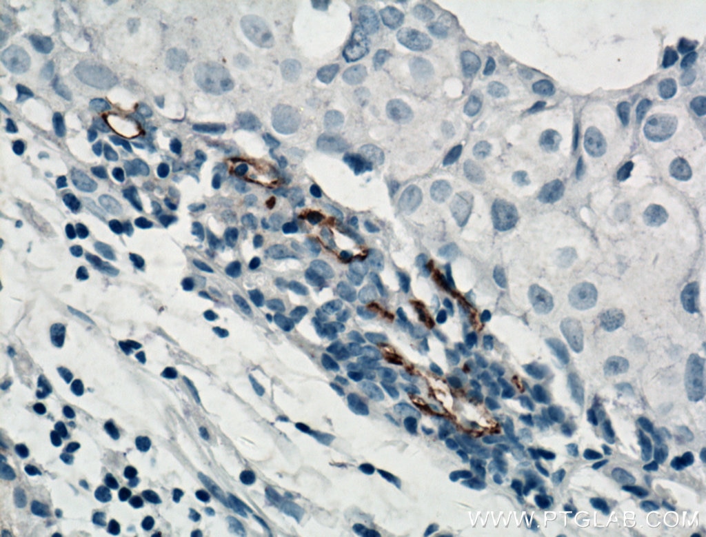 Immunohistochemistry (IHC) staining of human breast cancer tissue using CD133 Monoclonal antibody (66666-1-Ig)