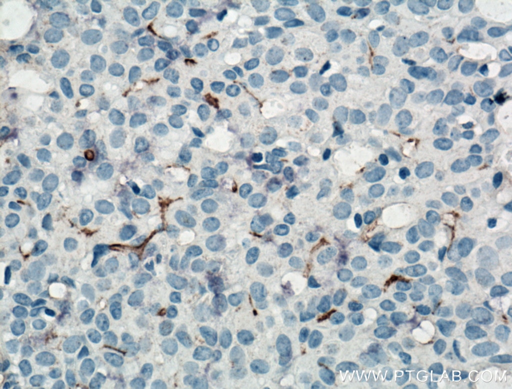 Immunohistochemistry (IHC) staining of human breast cancer tissue using CD133 Monoclonal antibody (66666-1-Ig)