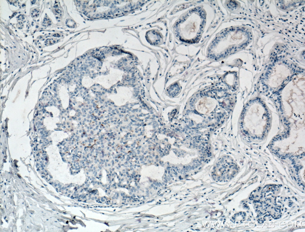 Immunohistochemistry (IHC) staining of human breast cancer tissue using CD133 Monoclonal antibody (66666-1-Ig)