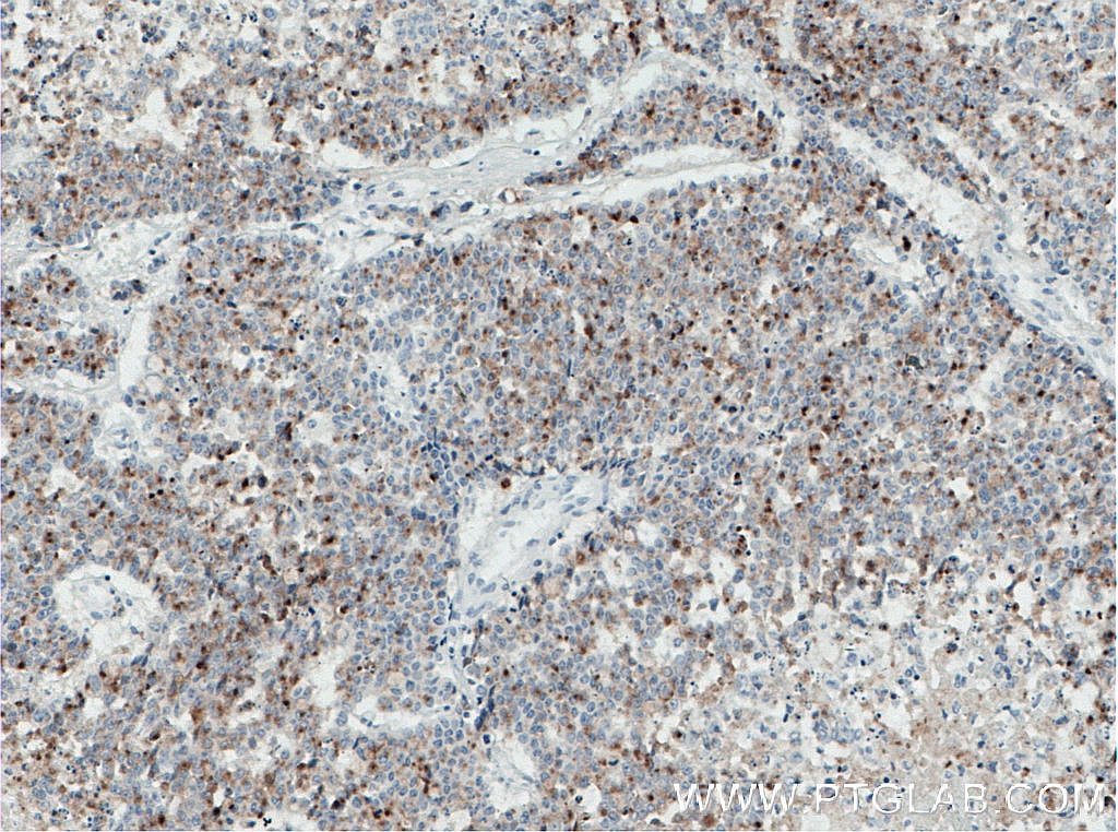 Immunohistochemistry (IHC) staining of human colon cancer tissue using CD133 Monoclonal antibody (66666-1-Ig)
