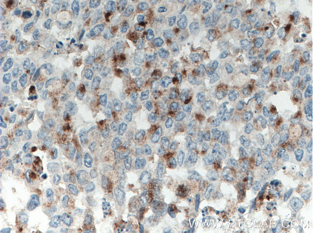 Immunohistochemistry (IHC) staining of human colon cancer tissue using CD133 Monoclonal antibody (66666-1-Ig)