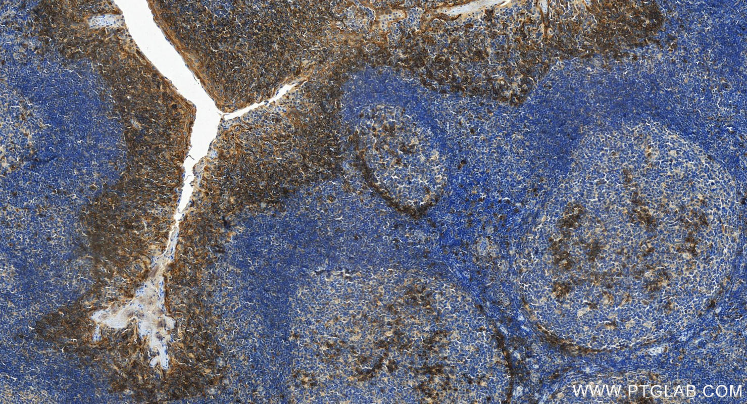 Immunohistochemistry (IHC) staining of human tonsillitis tissue using CD138/Syndecan-1 Polyclonal antibody (31341-1-AP)