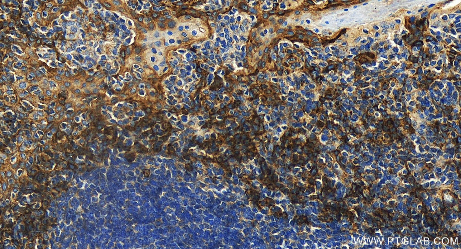 Immunohistochemistry (IHC) staining of human tonsillitis tissue using CD138/Syndecan-1 Polyclonal antibody (31341-1-AP)