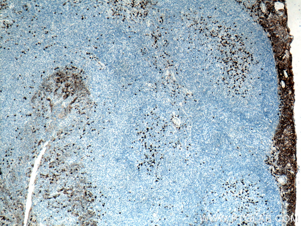 Immunohistochemistry (IHC) staining of human tonsillitis tissue using CD138/Syndecan-1 Monoclonal antibody (67155-1-Ig)