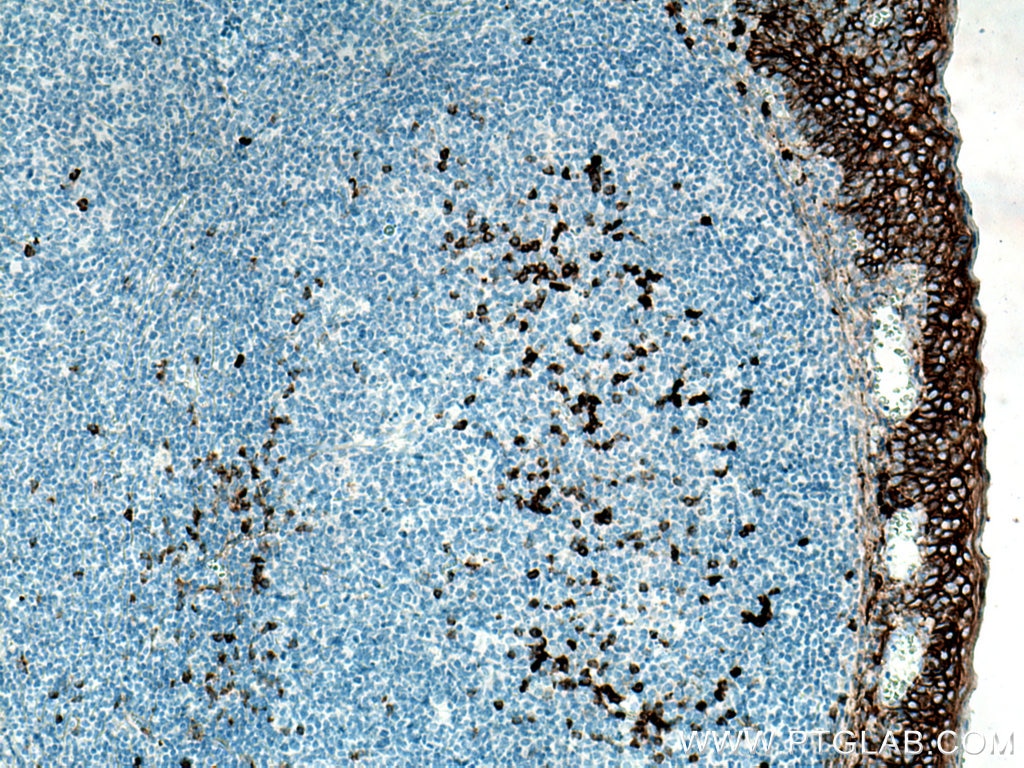 Immunohistochemistry (IHC) staining of human tonsillitis tissue using CD138/Syndecan-1 Monoclonal antibody (67155-1-Ig)