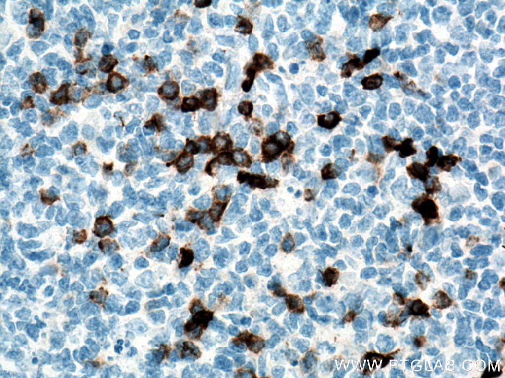 Immunohistochemistry (IHC) staining of human tonsillitis tissue using CD138/Syndecan-1 Monoclonal antibody (67155-1-Ig)