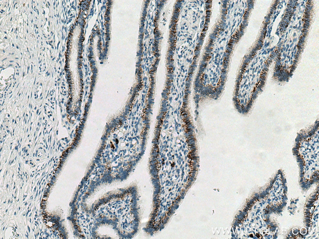 Immunohistochemistry (IHC) staining of human ovary tumor tissue using CD138/Syndecan-1 Monoclonal antibody (67155-1-Ig)