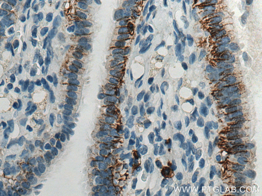 Immunohistochemistry (IHC) staining of human ovary tumor tissue using CD138/Syndecan-1 Monoclonal antibody (67155-1-Ig)