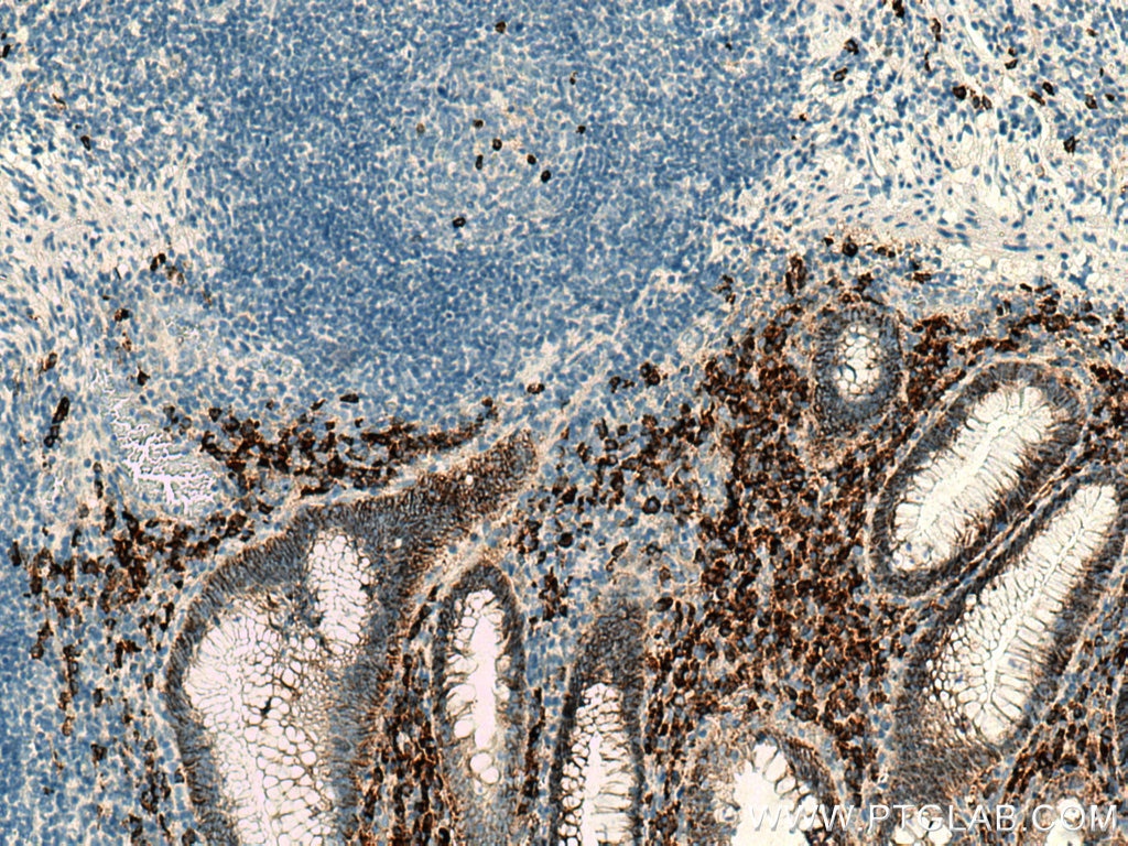 Immunohistochemistry (IHC) staining of human appendicitis tissue using CD138/Syndecan-1 Monoclonal antibody (67155-1-Ig)