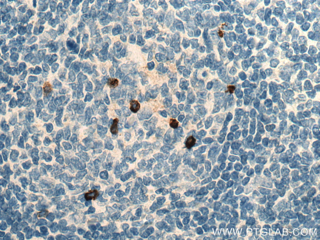 Immunohistochemistry (IHC) staining of human appendicitis tissue using CD138/Syndecan-1 Monoclonal antibody (67155-1-Ig)
