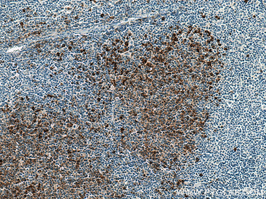 Immunohistochemistry (IHC) staining of human lymphoma tissue using CD138/Syndecan-1 Monoclonal antibody (67155-1-Ig)