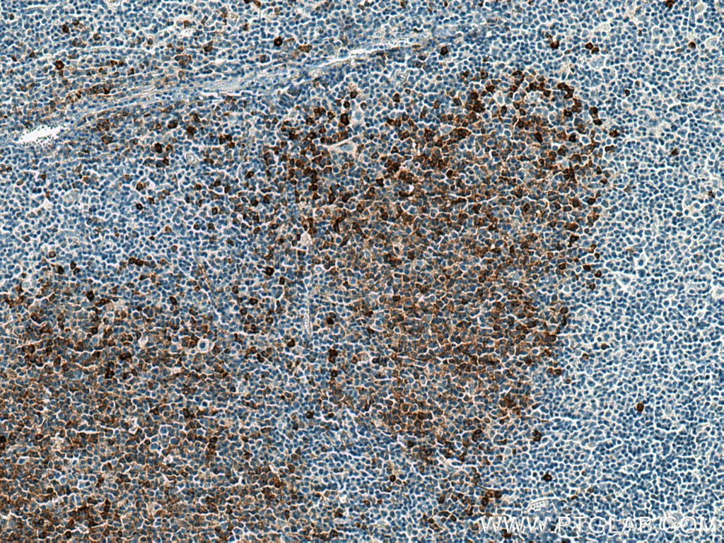 IHC staining of human lymphoma using 67155-1-Ig