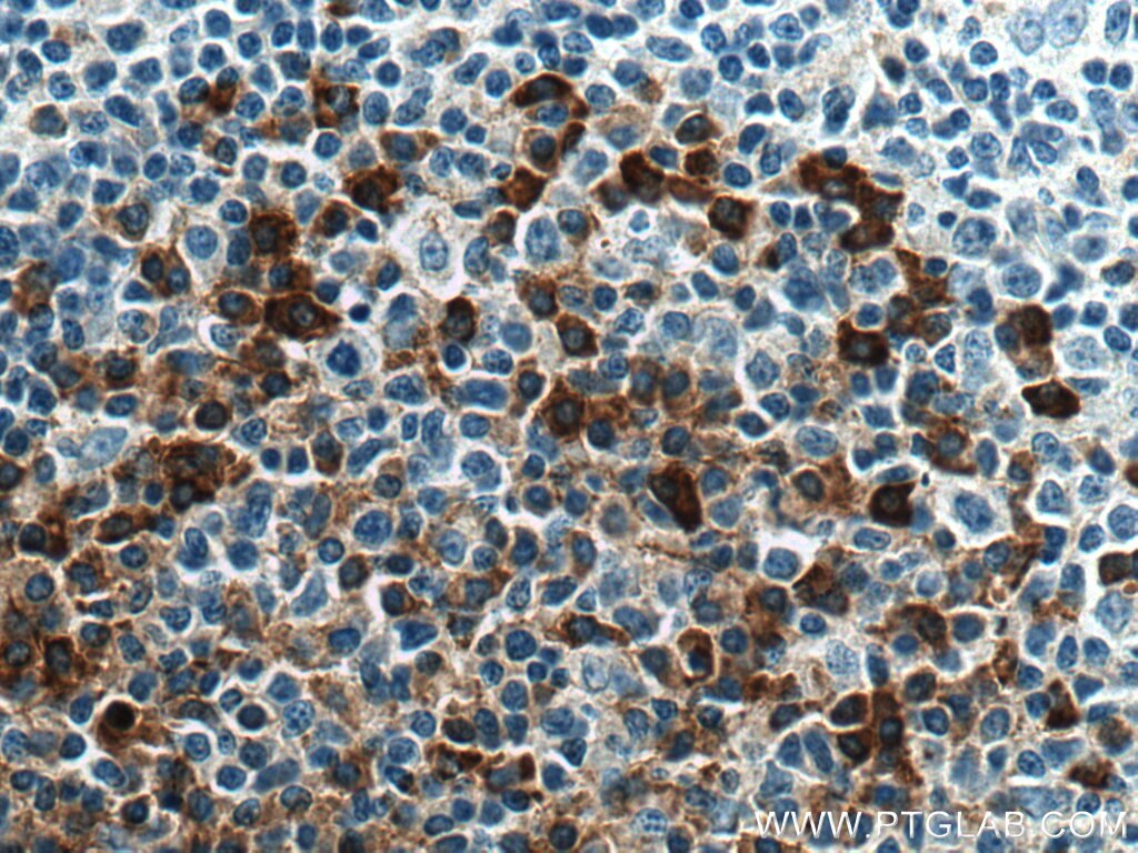 Immunohistochemistry (IHC) staining of human lymphoma tissue using CD138/Syndecan-1 Monoclonal antibody (67155-1-Ig)