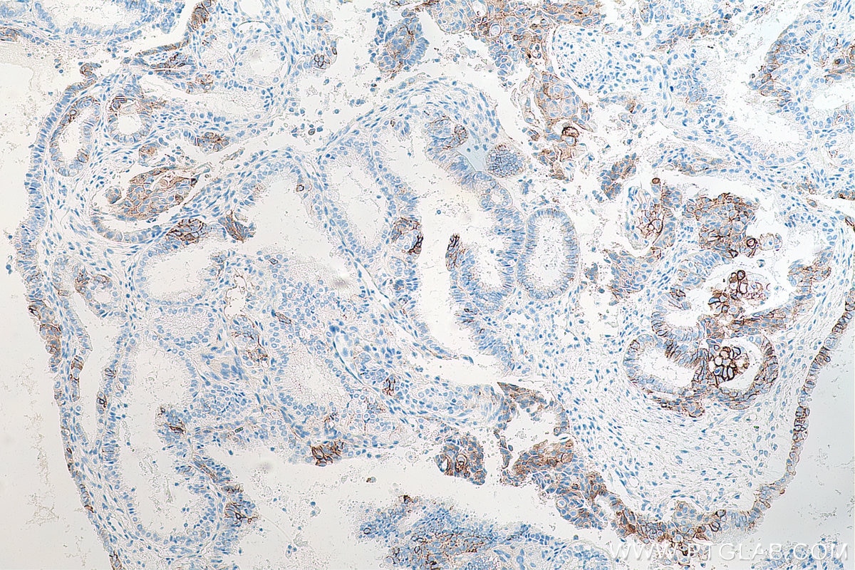 Immunohistochemistry (IHC) staining of human ovary tumor tissue using CD138/Syndecan-1 Monoclonal antibody (67155-1-Ig)
